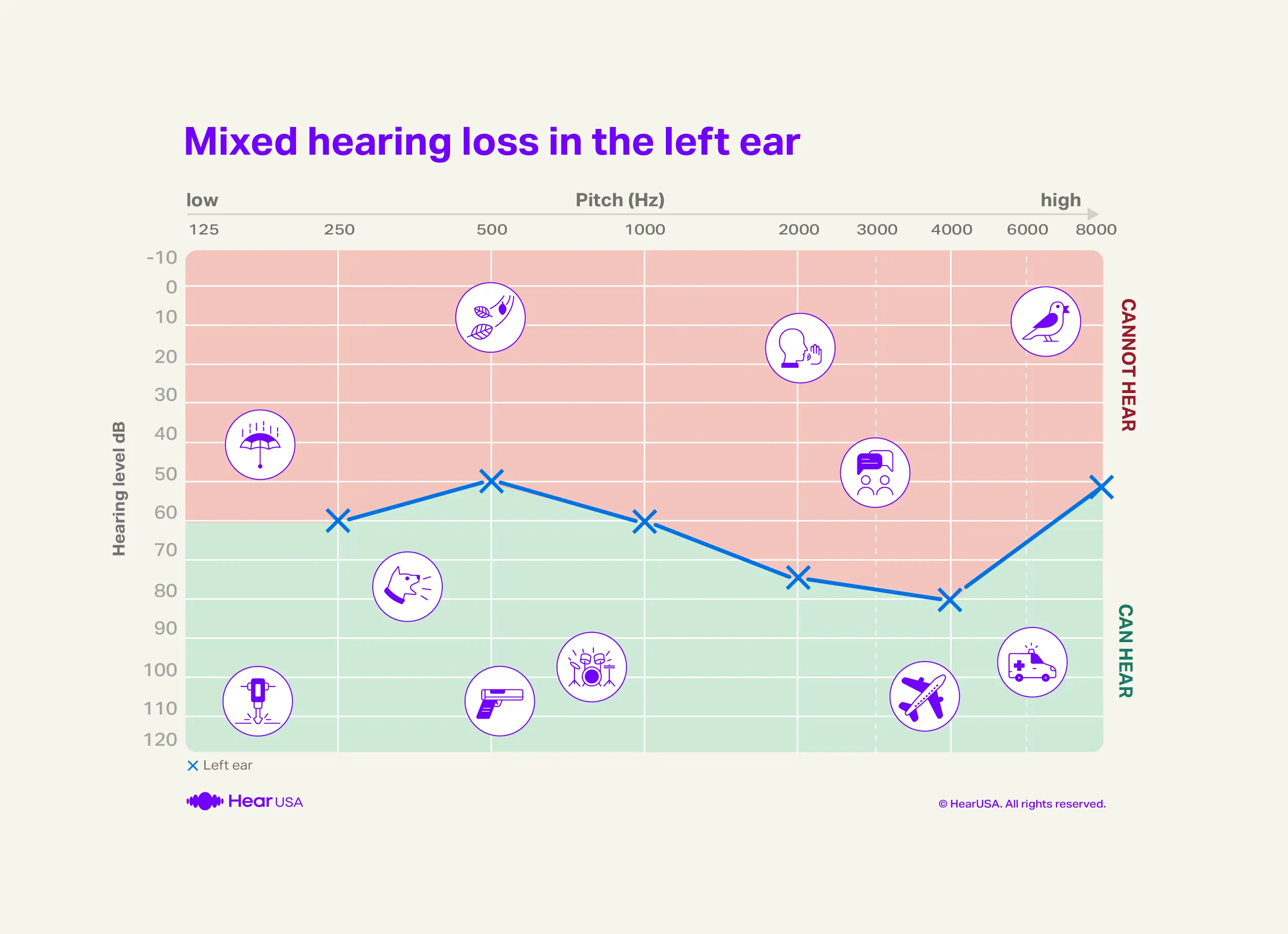 Mixed hearing loss audiogram